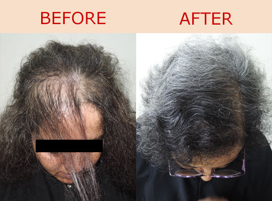 hair transplant - hair fixing - surgery before after photos - photography -  pictures | Best hair transplant in Mangalore